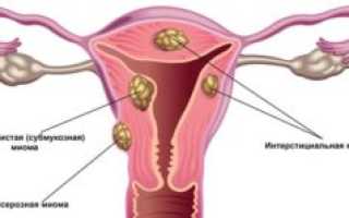 Миома и цистит -есть ли связь?
